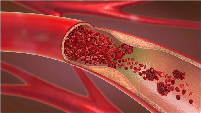 Заражение COVID-19 повышает риск легочной тромбоэмболии в течение 30 дней в 33 раза